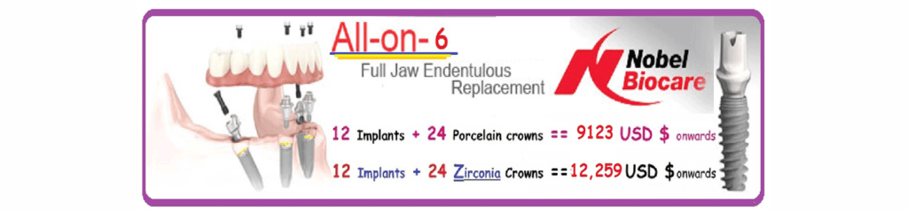 All-On-6 Dental Implants