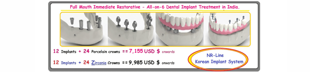 All-On-6 Dental Implants