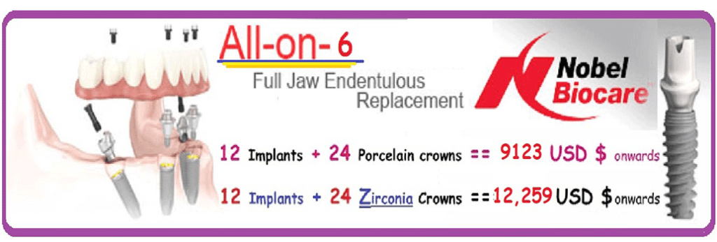 all on 6 dental implants