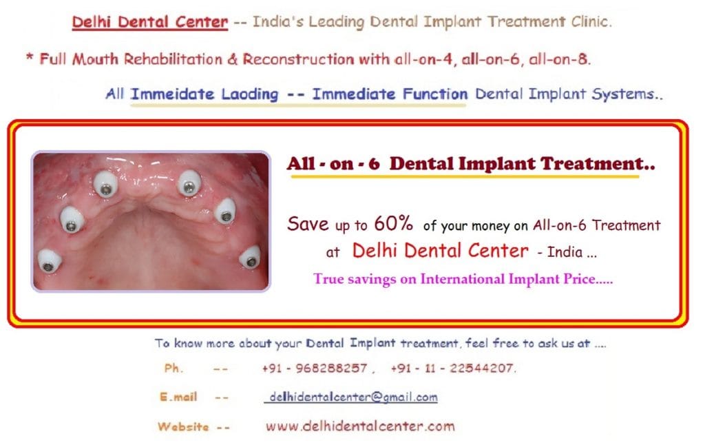 All on 6 Dental Implant