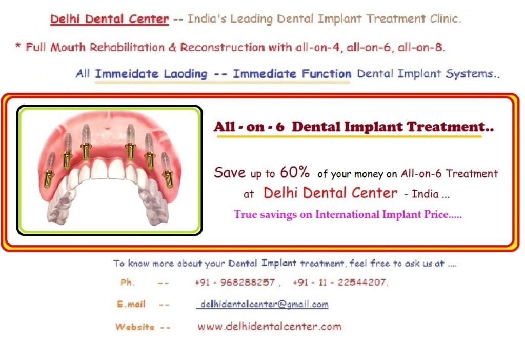 All on 6 Dental Implant