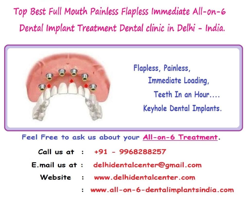 All on 6 Dental Implant