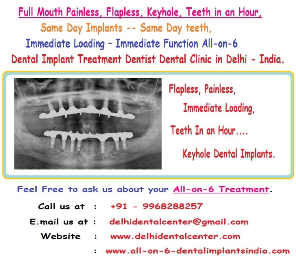 All on 6 Dental Implant