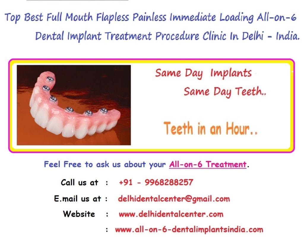 All on 6 Dental Implant