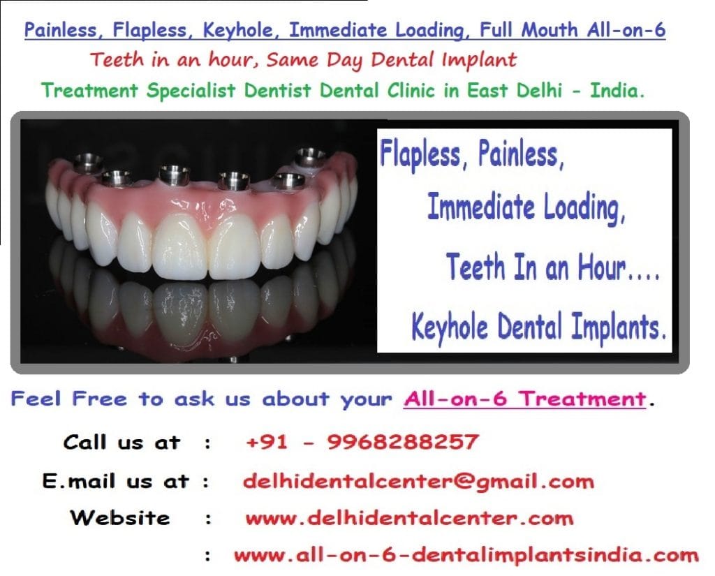 All on 6 Dental Implant