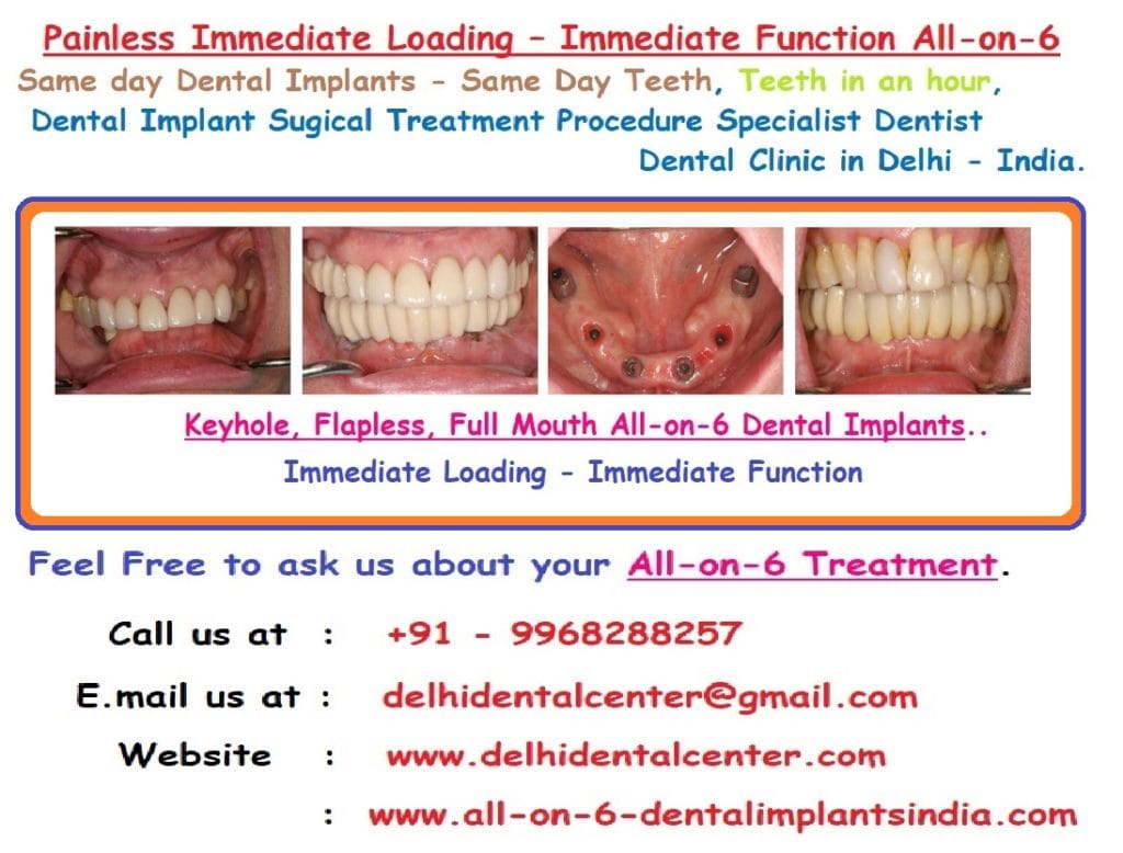 All on 6 Dental Implant
