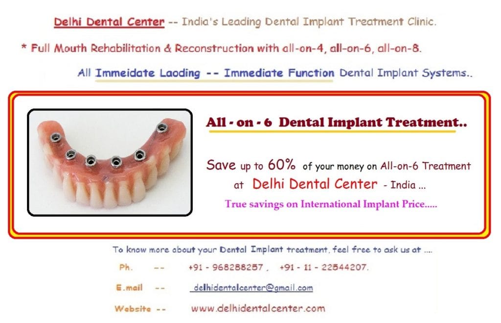 All on 6 Dental Implant