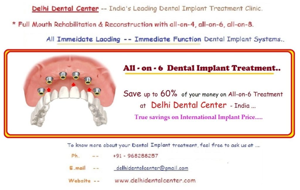 All on 6 Dental Implant